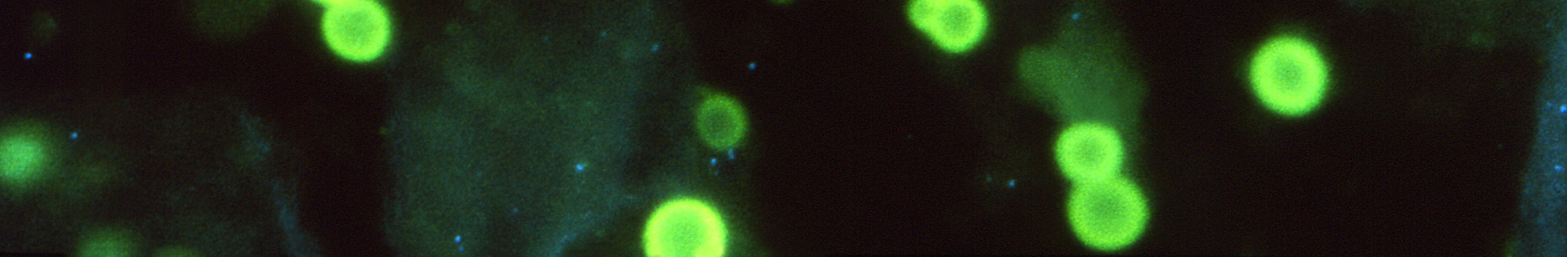fluorescent antibody (FA)-stained sputum specimen, revealed the presence of oval shaped, budding Cryptococcus neoformans yeast cells, KAplan/CDC 1972